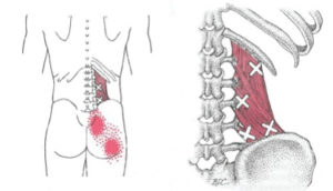 Triggerpunkter ländrygg